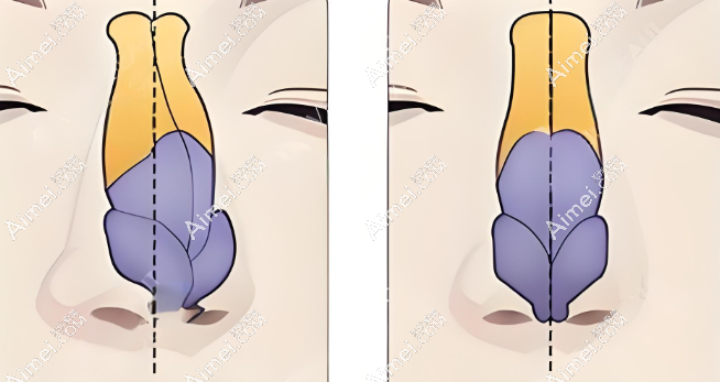 牛永敢鼻修复技术好