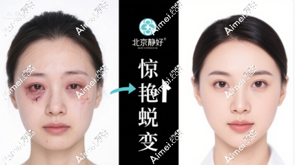 北京静好张大艳双眼皮修复价格