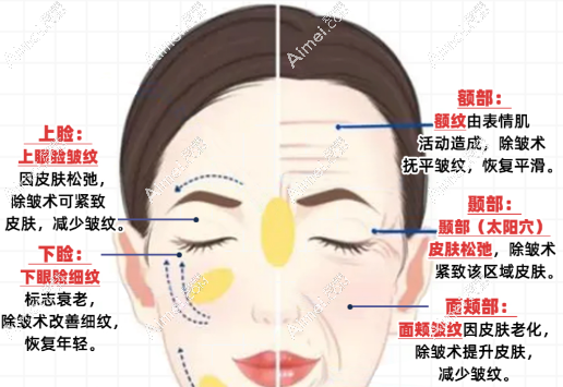 面部去皱