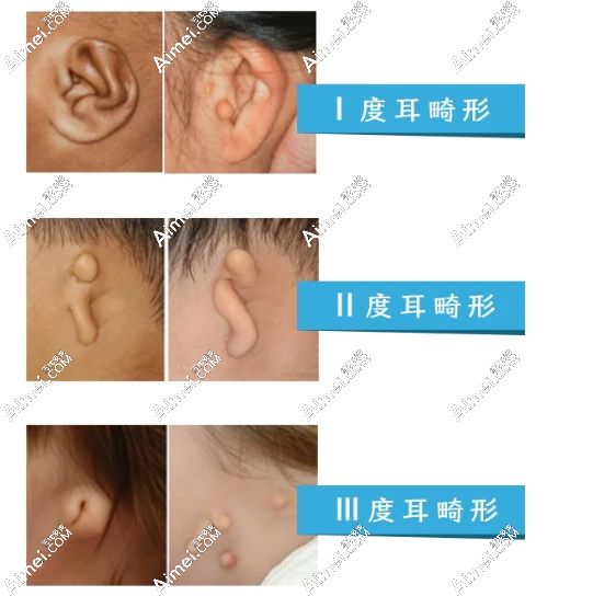 北京协和医院做耳再造手术费用解析:2025年安波价格体系与报销政策全公开