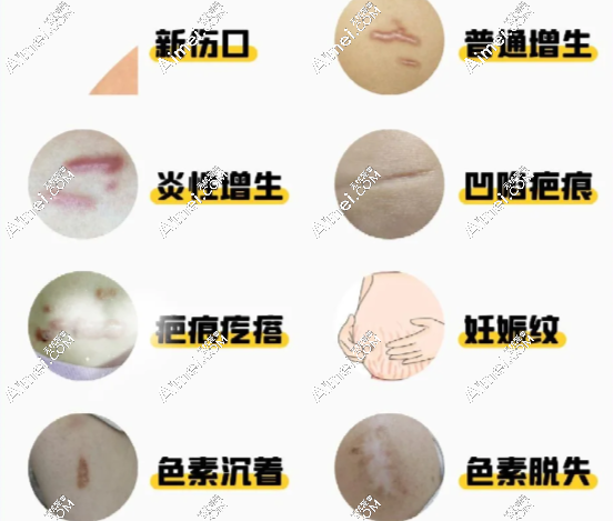 深圳鹏程医院疤痕科不能报销,但别担心,价格低到剁手!凹陷疤修复才6500,值哭​
