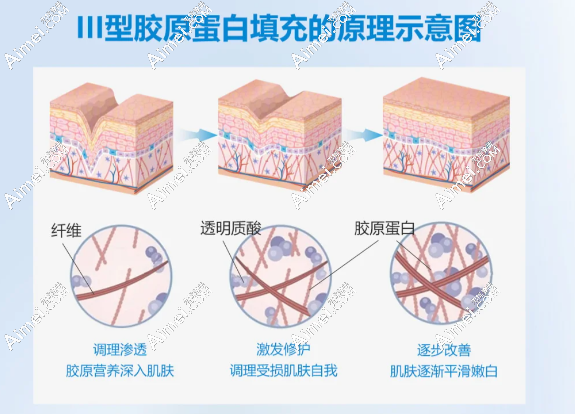 艾颜仕三型胶原蛋白可以去眼部细纹