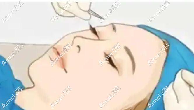 双眼皮 双眼皮