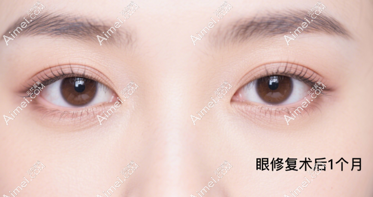 李月辉眼修复病例