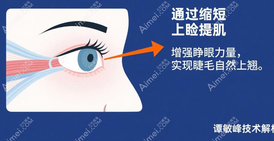 谭敏峰双眼皮提肌术后 3 年睫毛翘度保持 90% 的奥秘 谭敏峰双眼皮提肌术后 3 年睫毛翘度保持 90% 的奥秘