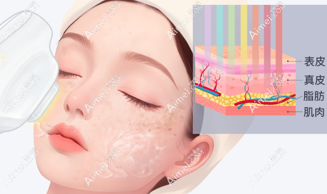 光子嫩肤第三天 光子嫩肤第三天