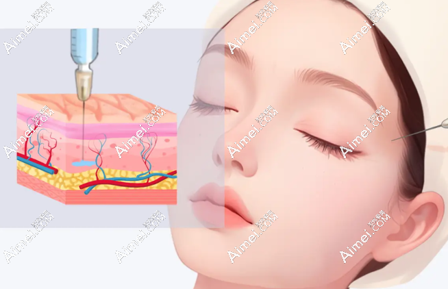 玻尿酸填充下巴