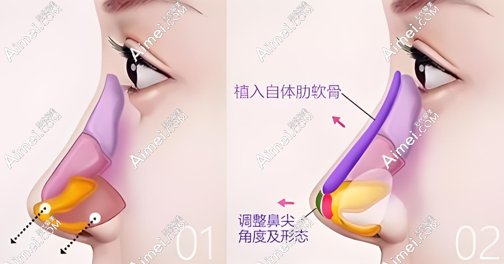 隆鼻整形