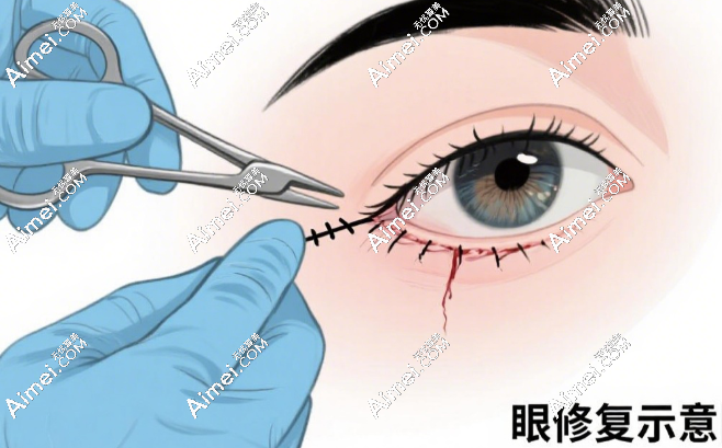 潘贰修复眼花了3万正常吗？对比6万高价病例，3万档属于中等价格也不算太贵