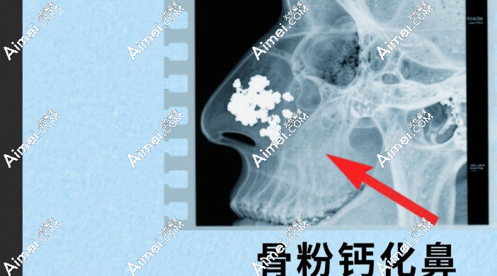 高三毕业照C位=玻尿酸隆鼻？医美师痛斥3类非法注射陷阱，开学或变塌鼻
