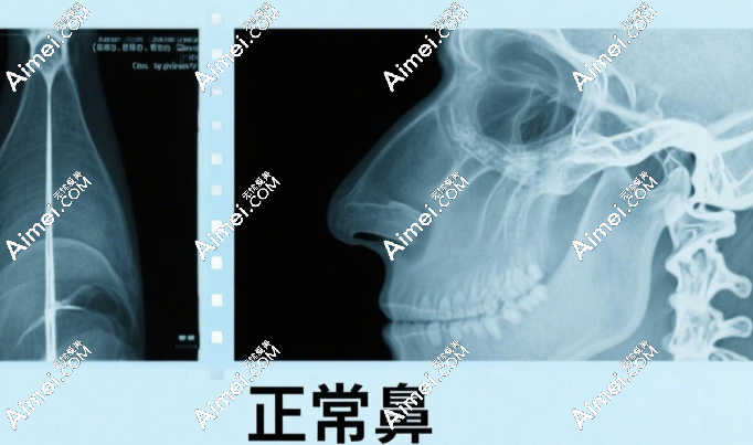 注射隆鼻