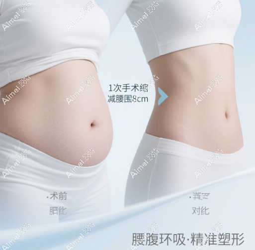腰腹环吸术后成效对比
