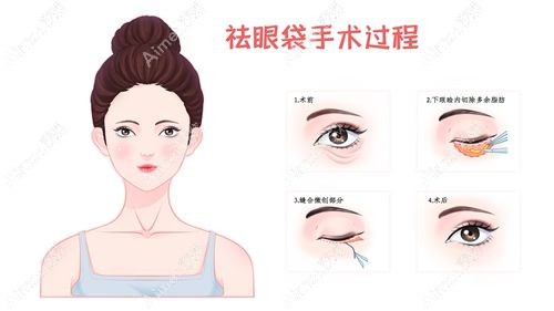 去眼袋真实范例