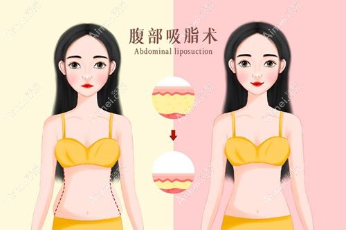 为什么说任学会擅长吸脂修复 为什么说任学会擅长吸脂修复