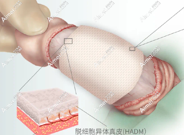 王文卫做生物补片增粗手术