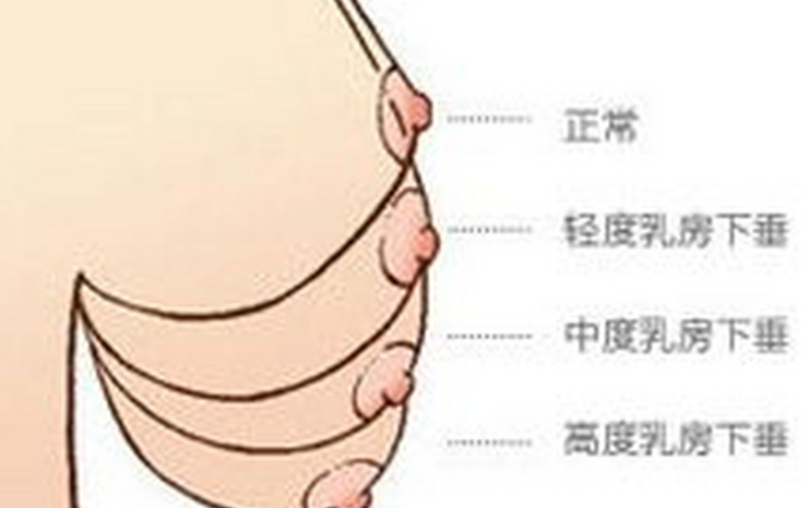 李建东维维胸提升术的价格