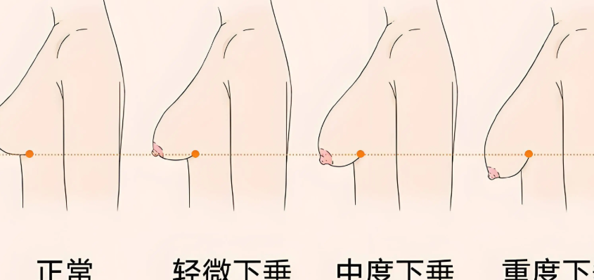 李建东维维胸提升术的技术
