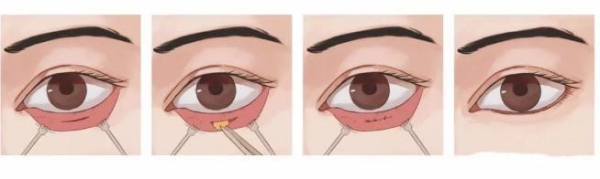 贺洁去眼袋怎么样