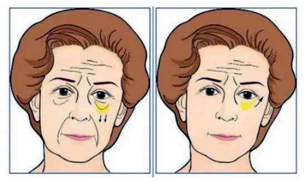 王杨和贺洁修复眼袋价格