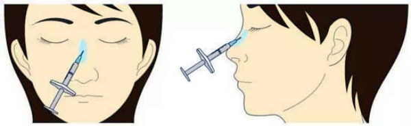 广州曙光张小芸注射隆鼻价格www.aimei.com
