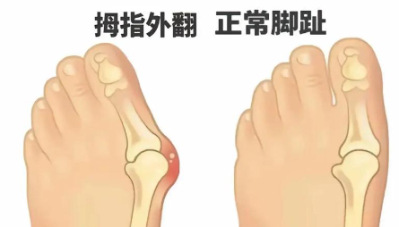 陈圣英和苏敬达谁厉害?陈圣英微孔祛大脚骨技术切口小(通常3-5毫米)疤痕隐蔽且不易复发...