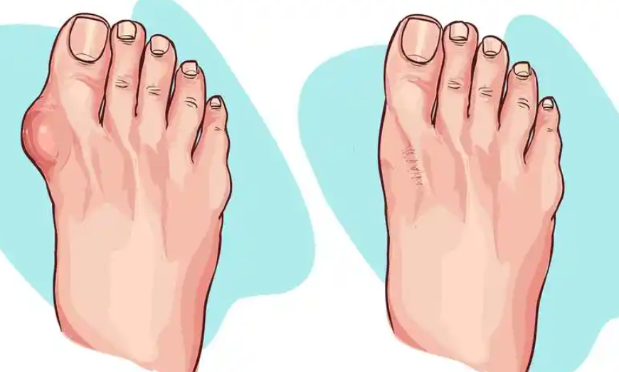 陈圣英治大脚骨可靠吗？陈圣英医生治疗大脚骨（拇外翻）经验丰富，微创技术+0.1毫米精度，复发率低于3%！