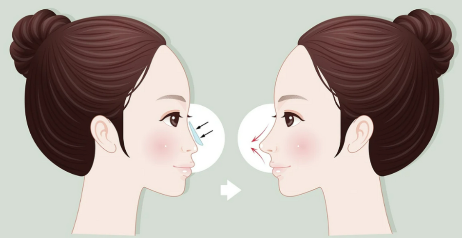 冯春雨鼻整形价格公开(当下版)