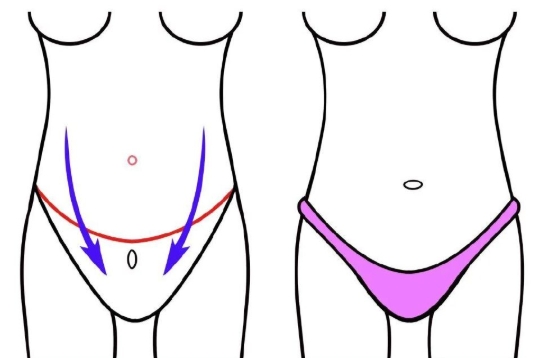 李海涛腹壁整形成功病例数量