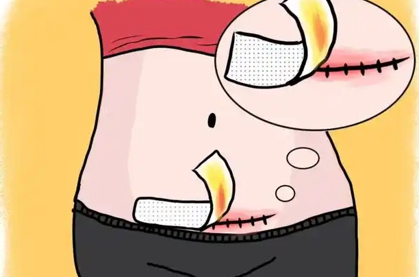 找上海李海涛医生做腹壁整形手术就诊建议