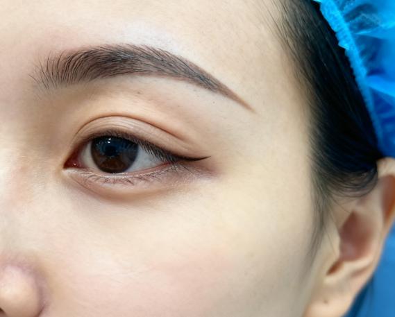 杜园园和其他做眼修复的医生在高难度失败眼修复的“动态疤痕处理”上的不同