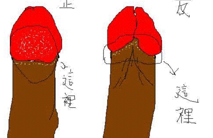王文卫延长术采用哪种手术方式?悬韧带切断术术后比例超自然