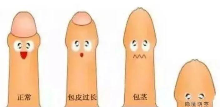 王文卫增粗延长手术