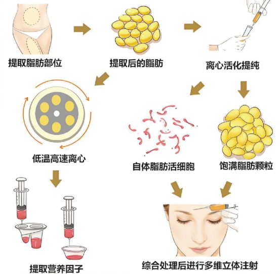 杭州脂肪填充大佬前10名:彭涛/汪峰/郭同荣,面部填充存活率达90%