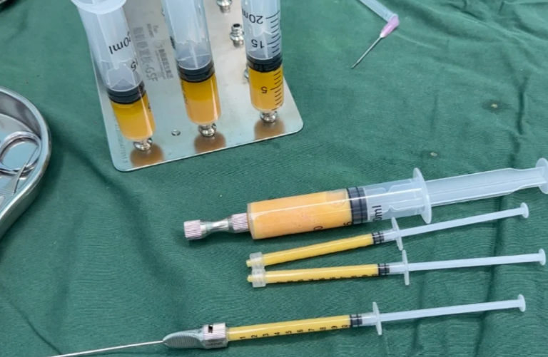 杭州脂肪填充医生前10名:彭涛/汪峰/郭同荣之外,这几位医生也各有“绝活”