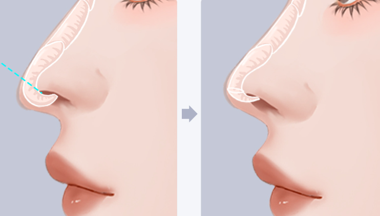 房志强做鹰钩鼻缩短口碑评价好,术后鼻型自然立体-顾客满意度高!