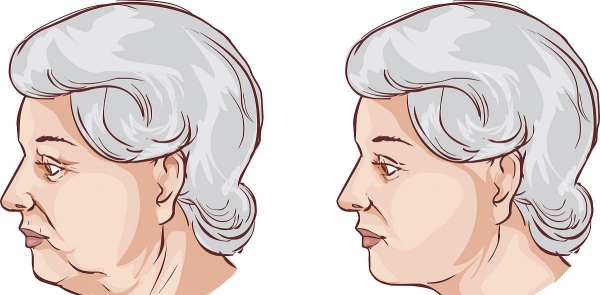 黄寅守做面部提升