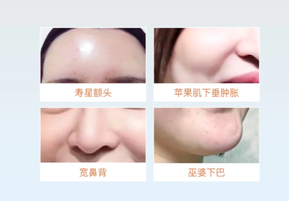 黎星脂肪修复价格多少？苹果肌修复3万+/馒化脸修复 5 万起，透明无套路