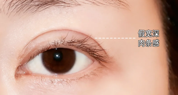 上海悦欧医疗美容做双眼皮修复多少钱?肉条眼修复2万起,张园园医生主刀