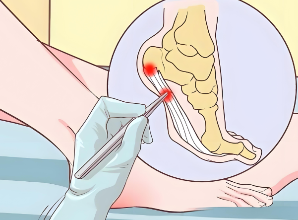 重庆李昕宇大脚骨手术价格表:微创手术1.5w重度畸形3w开放手术4w+软组织松解5k跖骨矫形8k+