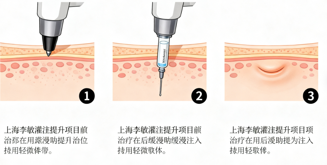 上海李敏灌注提升