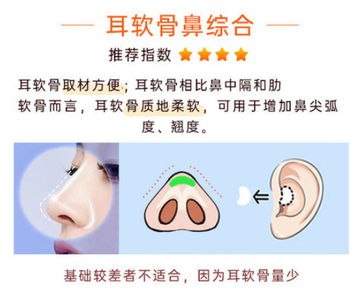 文丰做鼻子都是肋骨鼻吗