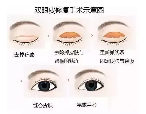 刘韶瑞修复双眼皮要多少钱