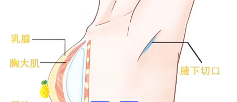 龙海波医生擅长的隆胸手术有哪些特点？