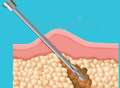 昆明何瑞蛟吸脂怎么样？反馈不错
