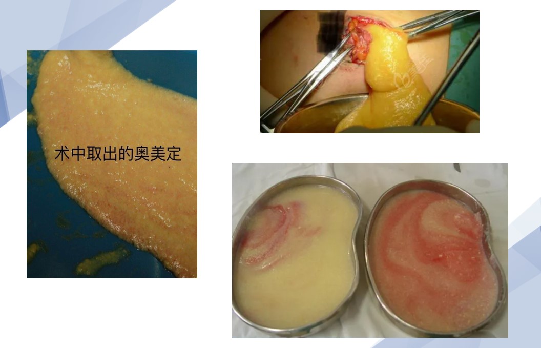 王洪取出的奥美定图片