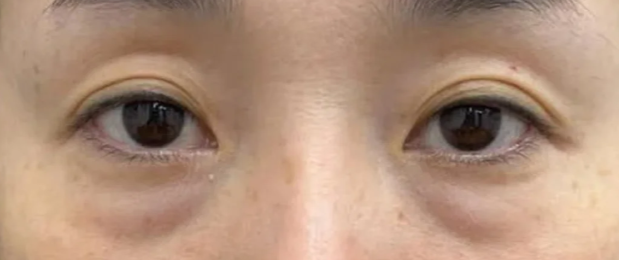 关于去眼袋的疑问,杭州健丽给了我安心答案