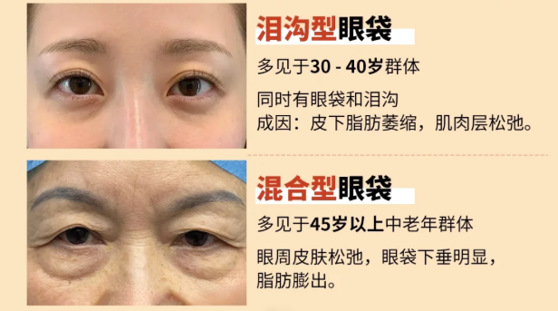 选去眼袋机构，我为什么选杭州健丽