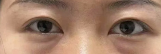 杭州健丽医疗美容去眼袋