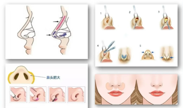 东莞壹加壹隆鼻材料