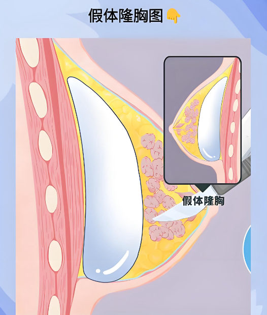 广州唐志荣隆胸怎么样